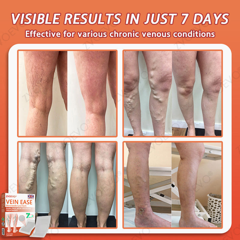 🪸💎Zvoevo® Vein Ease Microneedle Care Patch(For Spider Veins, Varicose Veins, Swelling & Leg Fatigue) - Last Day Promotion 50% OFF