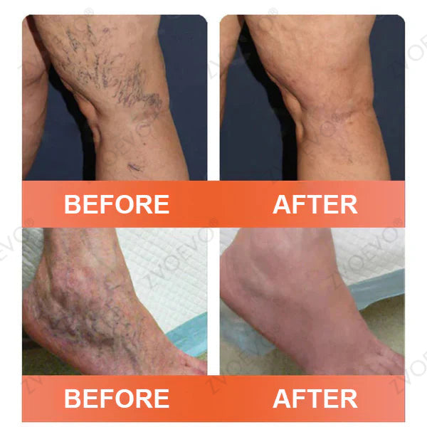 🪸💎Zvoevo® Vein Ease Microneedle Care Patch(For Spider Veins, Varicose Veins, Swelling & Leg Fatigue) - Last Day Promotion 50% OFF