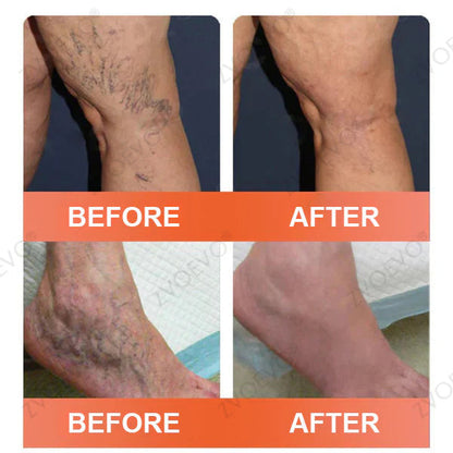 🪸💎Zvoevo® Vein Ease Microneedle Care Patch(For Spider Veins, Varicose Veins, Swelling & Leg Fatigue) - Last Day Promotion 50% OFF