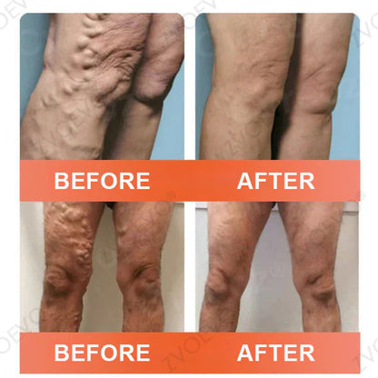 🪸💎Zvoevo® Vein Ease Microneedle Care Patch(For Spider Veins, Varicose Veins, Swelling & Leg Fatigue) - Last Day Promotion 50% OFF